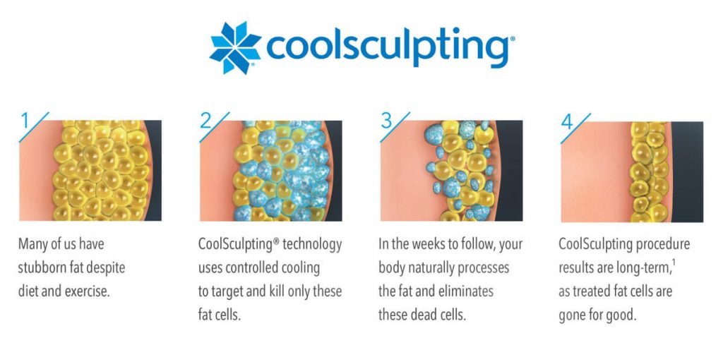 Illustration how coolsculpting works