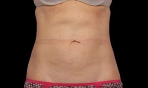 After CoolSculpting Abdomen