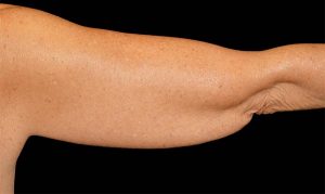 Before CoolSculpting Arm